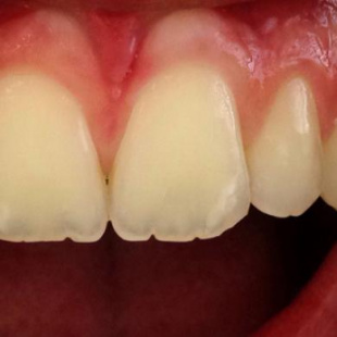 SMILE LITE + SMILE CAPTURE NEW