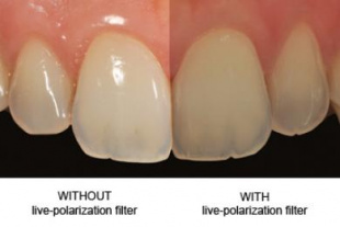 SMILE LITE + SMILE CAPTURE NEW