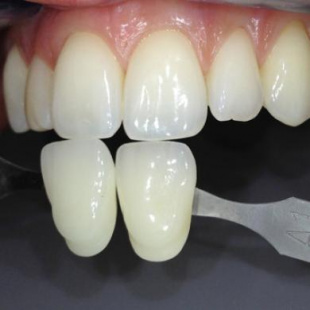 SMILE LITE + SMILE CAPTURE NEW