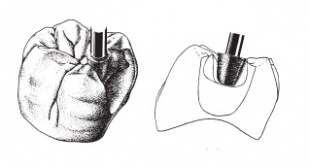 All Ceramic Preparation